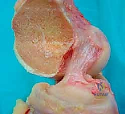 تشخيص إصابات الركبة