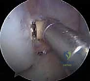 التشريح الدقيق لحزم الرباط الصليبي