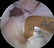 مقارنة بين تقنيات الرباط الصليبي