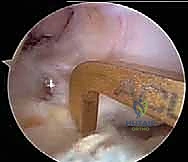 أسباب تمزق الرباط الصليبي