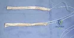 صورة توضيحية لـ إعادة بناء الرباط الصليبي الأمامي المزدوج التشريحي: استعادة كامل وظيفة الركبة مع الأستاذ الدكتور محمد هطيف في صنعاء