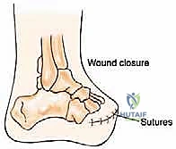 Mastering Foot & Ankle Amputations: Lisfranc and Chopart Techniques