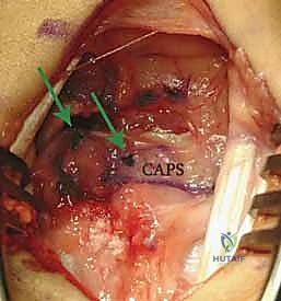 Mastering Open Scapholunate Ligament Repair and Dorsal Capsulodesis Augmentation: An Intraoperative Guide