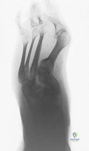 تنظير عظم منتصف القدم بالتثبيت الخارجي: حل متطور لتشوهات القدم المعقدة مع الأستاذ الدكتور محمد هطيف في صنعاء