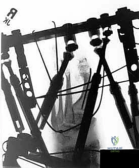 تفاصيل الإجراء الجراحي الدقيق لتنظير عظم منتصف القدم باستخدام منشار الجيجلي