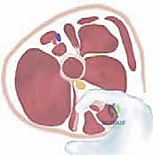 Illustration of spastic hip disease - Dr. Mohammed Hutaif