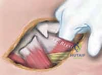 صورة توضيحية لـ إطالة أوتار الركبة والعضلات المقربة لعلاج خلع الورك التشنجي: دليل شامل للمرضى