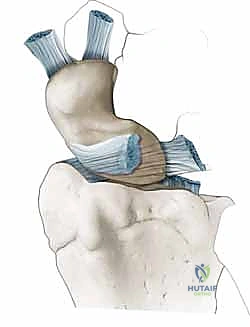 Dorsal Capsulodesis for Scapholunate Instability: A Masterclass