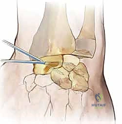تثبيت المحفظة الظهرية لعلاج عدم استقرار الرسغ الزورقي الهلالي: دليل شامل للمرضى مع الأستاذ الدكتور محمد هطيف