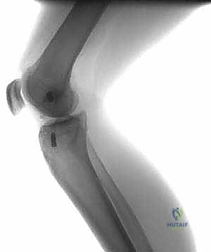 صورة توضيحية لـ إعادة بناء الرباط الصليبي الأمامي التصحيحية: حل شامل لحالات الفشل الجراحي السابق في صنعاء مع الأستاذ الدكتور محمد هطيف