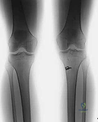 صورة توضيحية لـ إعادة بناء الرباط الصليبي الأمامي التصحيحية: حل شامل لحالات الفشل الجراحي السابق في صنعاء مع الأستاذ الدكتور محمد هطيف