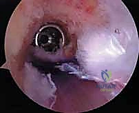 صورة توضيحية لـ إعادة بناء الرباط الصليبي الأمامي التصحيحية: حل شامل لحالات الفشل الجراحي السابق في صنعاء مع الأستاذ الدكتور محمد هطيف