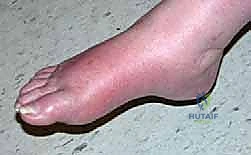 تثبيت القدم السكرية شاركو جراحيًا: استعادة الوظيفة ومنع البتر مع الأستاذ الدكتور محمد هطيف