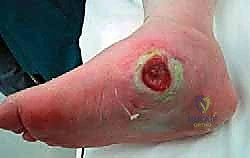 العلاج التحفظي وتخفيف الأحمال عن قدم شاركو