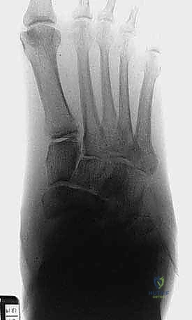 انهيار قوس القدم السكرية وفقدان البنية الهيكلية