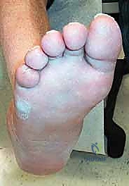 أعراض قدم شاركو الحادة من تورم واحمرار