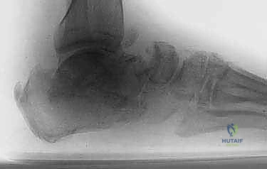 التهاب العظام وتدمير الأنسجة المؤدي لخطر البتر