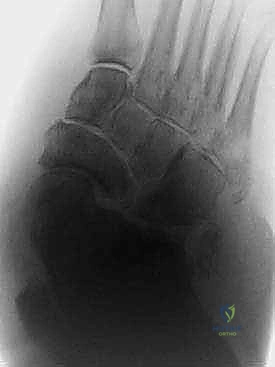 تقرحات القدم السكرية العميقة الناتجة عن البروز العظمي