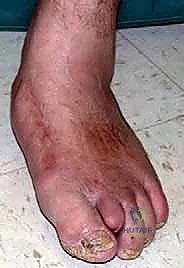 القرار الجراحي لتثبيت القدم بعد فشل العلاج التحفظي