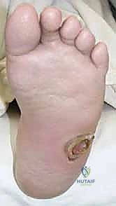 استخدام جهاز إليزروف للتثبيت الخارجي في الحالات المعقدة