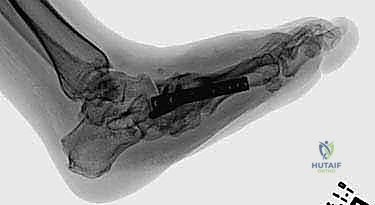 تطويل الأوتار وإزالة العظام البارزة جراحياً