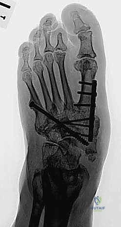 التخطيط الجراحي ثلاثي الأبعاد قبل العملية