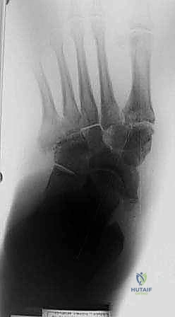 الأستاذ الدكتور محمد هطيف رائد جراحة العظام والمفاصل