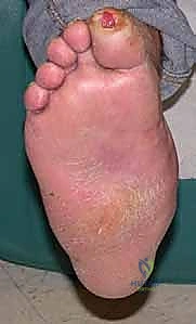 تشوهات مفصل شاركو المعقدة في القدم السكرية