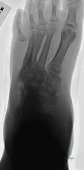 تدمير العظام في مفصل شاركو المتقدم