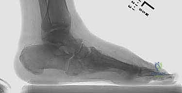 عوامل الخطر المؤدية لتطور قدم شاركو