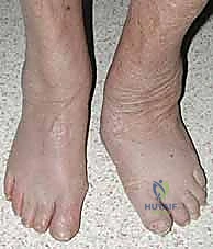 تنظيف المفاصل وإزالة الأنسجة التالفة