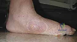 صورة توضيحية لـ تثبيت المفصل بالمسامير المحورية لعلاج تشوه شاركو في منتصف القدم: دليل شامل للمرضى مع الأستاذ الدكتور محمد هطيف