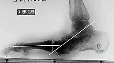 صورة توضيحية لـ تثبيت المفصل بالمسامير المحورية لعلاج تشوه شاركو في منتصف القدم: دليل شامل للمرضى مع الأستاذ الدكتور محمد هطيف