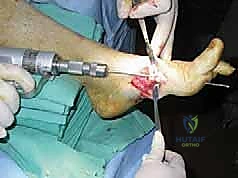 توضيح تشريحي لمنتصف القدم وتشوه شاركو