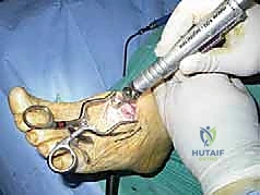 عوامل الخطر وتأثيرها على تطور المرض