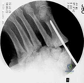 مراحل تدمير العظام في قدم شاركو