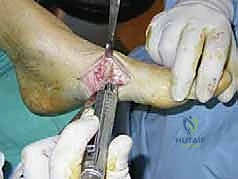 صورة توضيحية لـ تثبيت المفصل بالمسامير المحورية لعلاج تشوه شاركو في منتصف القدم: دليل شامل للمرضى مع الأستاذ الدكتور محمد هطيف