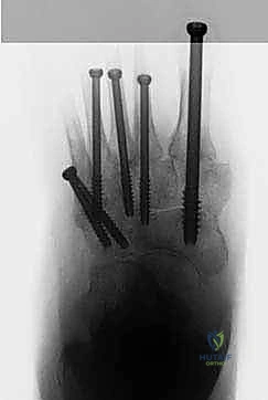 إدخال المسامير المحورية الصلبة داخل العظام