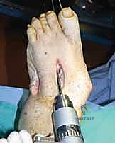 إعادة محاذاة العظام وتصحيح التشوه