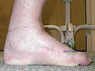 Surgical technique step for Axial Screw Technique for Midfoot Arthrodesis in Charcot Foot Deformities