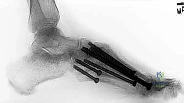 الخيارات العلاجية التحفظية قبل التدخل الجراحي