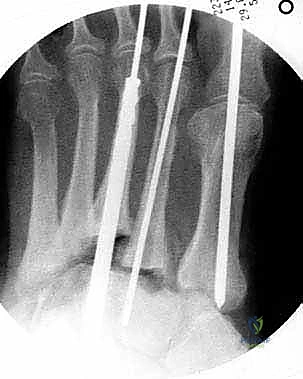 التخطيط الجراحي قبل العملية