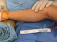 تخطيط وتحديد مكان الشق الجراحي