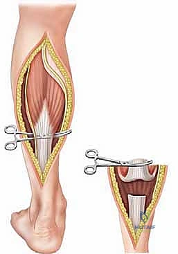 إجراء القطع الدقيق في اللفافة