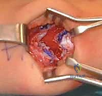 صورة ختامية توضح الفرحة بالشفاء واستعادة الحركة