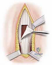 خطوات إجراء الشق الجراحي بدقة