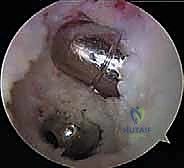 Posterior Cruciate Ligament Reconstruction: An Intraoperative Masterclass