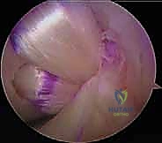 Should plates and screws be removed after bone fractures heal?