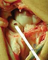 Scapholunate Instability: A Masterclass in Dorsal Ligament-Splitting Capsulotomy and Brunelli Tenodesis