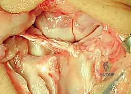 Scapholunate Instability: A Masterclass in Dorsal Ligament-Splitting Capsulotomy and Brunelli Tenodesis